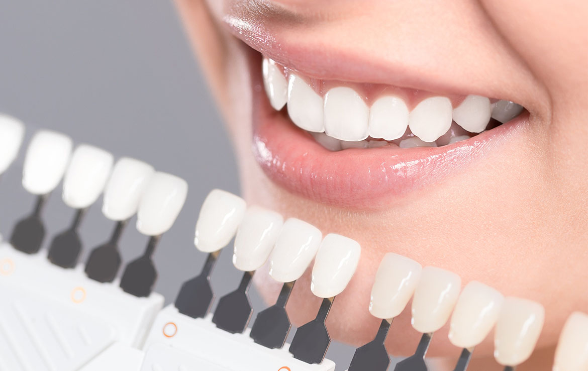 Veneers