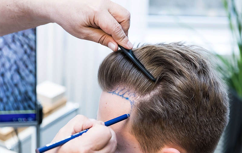 Hair Transplant in Turkey- Procedure, Costs, and Post-Transplant Care 1