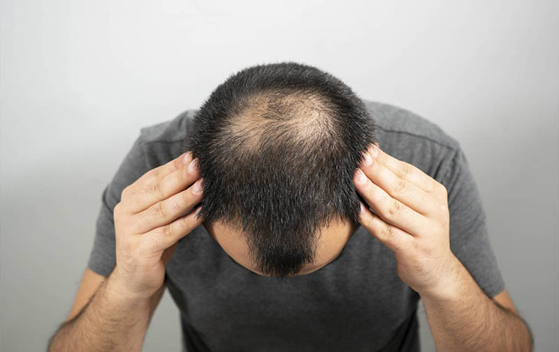 Hair Loss For Teenagers – Reasons and How To Prevent 2